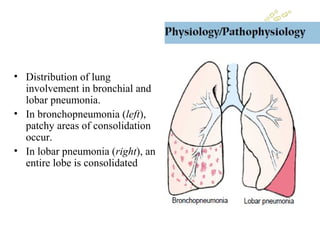 • Distribution of lung
involvement in bronchial and
lobar pneumonia.
• In bronchopneumonia (left),
patchy areas of consolidation
occur.
• In lobar pneumonia (right), an
entire lobe is consolidated
 