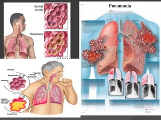 Pneumonia