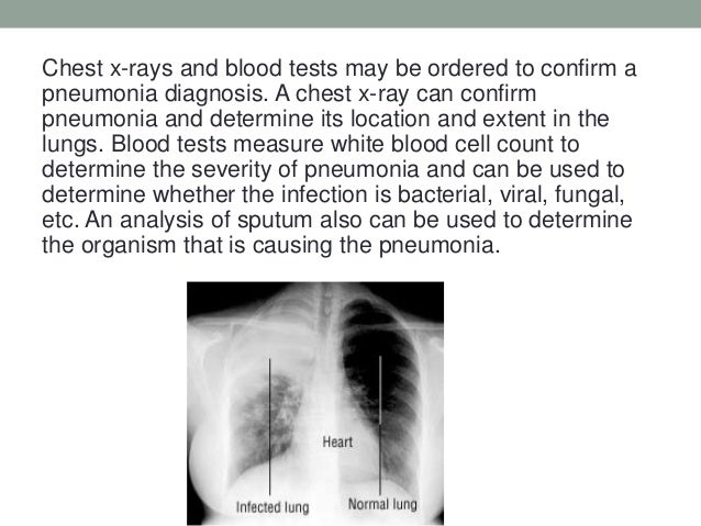 Pneumonia