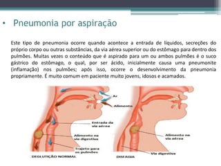 • Pneumonia por aspiração
Este tipo de pneumonia ocorre quando acontece a entrada de líquidos, secreções do
próprio corpo ou outras substâncias, da via aérea superior ou do estômago para dentro dos
pulmões. Muitas vezes o conteúdo que é aspirado para um ou ambos pulmões é o suco
gástrico do estômago, o qual, por ser ácido, inicialmente causa uma pneumonite
(inflamação) nos pulmões; após isso, ocorre o desenvolvimento da pneumonia
propriamente. É muito comum em paciente muito jovens, idosos e acamados.
 