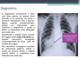 Diagnóstico
O diagnóstico inicialmente é feito
com base apenas no exame físico
alterado e na presença de sinais e
sintomas compatíveis com a doença.
Alguns exames complementares
podem ser importantes para
confirmar o diagnóstico e ajudar a
definir o tratamento mais adequado
para cada caso.
Geralmente o médico utiliza exames
de imagem como raios X de tórax ou ,
quando necessário, tomografia
computadorizada de tórax além de
exames de sangue
Para identificar o patógeno causador
da pneumonia pode-se utilizar o
exame do escarro. Assim, o médico
poderá definir o antibiótico mais
indicado para cada caso.
Opacidade alveolar
de limites mal
definidos
 