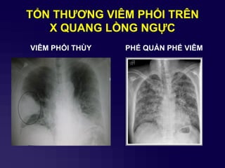 TỔN THƢƠNG VIÊM PHỔI TRÊN
X QUANG LỒNG NGỰC
VIÊM PHỔI THÙY PHẾ QUẢN PHẾ VIÊM
 