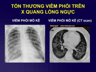 TỔN THƢƠNG VIÊM PHỔI TRÊN
X QUANG LỒNG NGỰC
VIÊM PHỔI MÔ KẼ VIÊM PHỔI MÔ KẼ (CT scan)
 