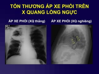 TỔN THƢƠNG ÁP XE PHỔI TRÊN
X QUANG LỒNG NGỰC
ÁP XE PHỔI (XQ thẳng) ÁP XE PHỔI (XQ nghiêng)
 