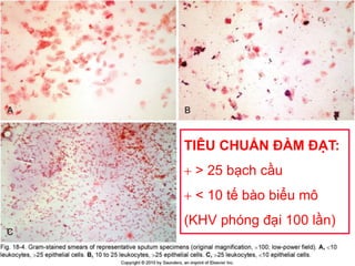 TIÊU CHUẨN ĐÀM ĐẠT:
 > 25 bạch cầu
 < 10 tế bào biểu mô
(KHV phóng đại 100 lần)
 