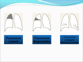 Pneumonia
Lobaris
Pneumonia
Lobularis
(Bronkopneumonia)
Pneumonia
Segmentalis
 