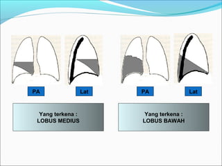 PA PALat Lat
Yang terkena :
LOBUS MEDIUS
Yang terkena :
LOBUS BAWAH
 