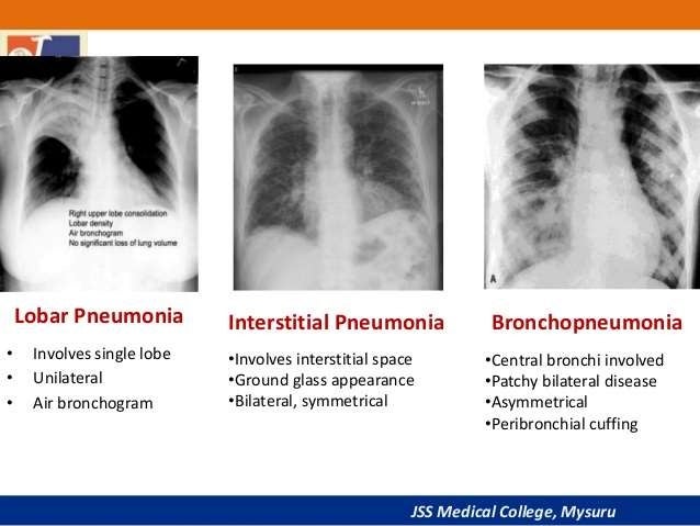 pneumonia