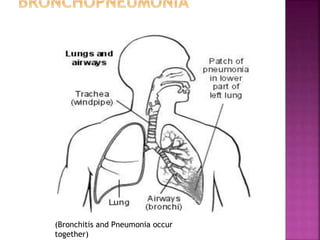 (Bronchitis and Pneumonia occur
together)
 