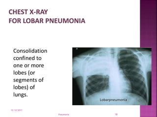 12/12/2011
Pneumonia 18
Lobarpneumonia
Consolidation
confined to
one or more
lobes (or
segments of
lobes) of
lungs.
 