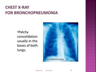 12/12/2011Pneumonia 19
Bronchopneumonia
•Patchy
consolidation
usually in the
bases of both
lungs.
 