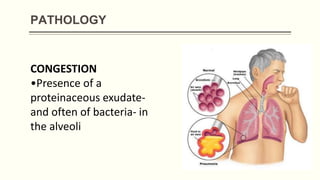 PATHOLOGY
CONGESTION
•Presence of a
proteinaceous exudate-
and often of bacteria- in
the alveoli
 