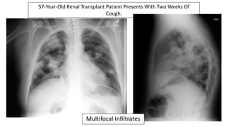 Multifocal Infiltrates EMGuideWire's Radiology Reading Room: Pneumonia | PPTX