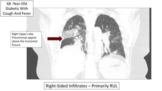 73-Year-Old With
Fever, Cough And
Confusion
Right Middle Lobe Pneumonia
 