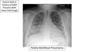 The Patient Presents To The ED 24 Hours Later With Cough + Persistent Tachycardia & Hypoxia.
Worsening Pneumonia Despite T...