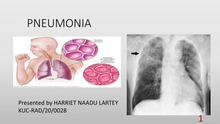 PNEUMONIA
Presented by HARRIET NAADU LARTEY
KUC-RAD/20/0028
1
 