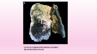 LUNG IN LOBAR PNEUMONIA IN GREY
HEAPTISATION STAGE
 