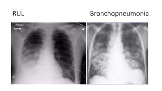 RUL Bronchopneumonia
 
