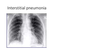 Interstitial pneumonia
 