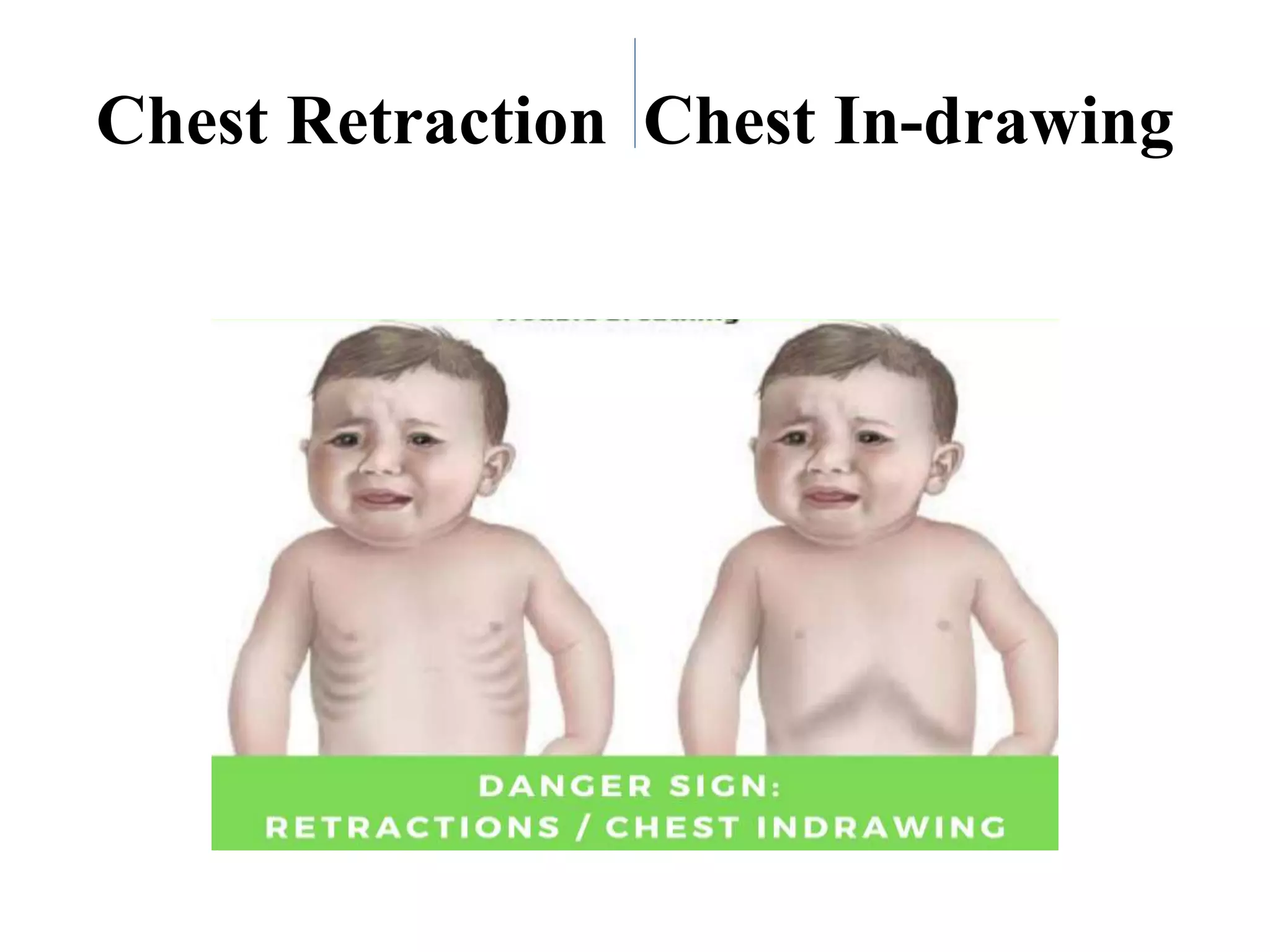 Pneumonia BNS Nursing .pptx