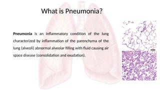 Recent update of Pneumonia and it's management | PPTX