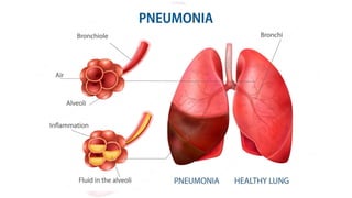 Recent update of Pneumonia and it's management | PPTX