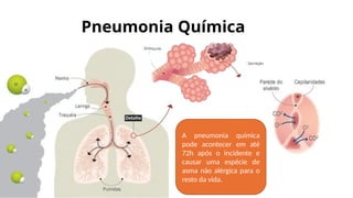 A pneumonia química
pode acontecer em até
72h após o incidente e
causar uma espécie de
asma não alérgica para o
resto da vida.
Pneumonia Química
 