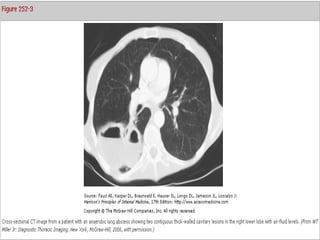 pneumonia.ppt and others lung infections | PPT