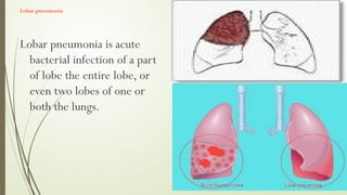 pneumonia Briefly explanation for understanding pptx | PPTX
