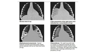 Pneumonia a lung infection causing cough, fever, and dyspnea. | PPTX