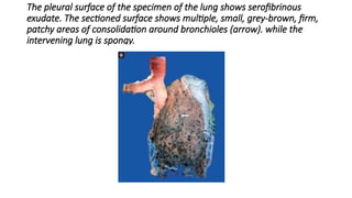 The pleural surface of the specimen of the lung shows serofibrinous
exudate. The sectioned surface shows multiple, small, grey-brown, firm,
patchy areas of consolidation around bronchioles (arrow). while the
intervening lung is spongy.
 