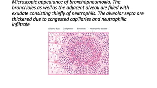 Microscopic appearance of bronchopneumonia. The
bronchioles as well as the adjacent alveoli are filled with
exudate consisting chiefly of neutrophils. The alveolar septa are
thickened due to congested capillaries and neutrophilic
infiltrate
 