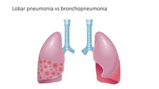Lobar pneumonia vs bronchopneumonia
 