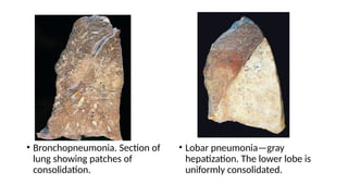 • Bronchopneumonia. Section of
lung showing patches of
consolidation.
• Lobar pneumonia—gray
hepatization. The lower lobe is
uniformly consolidated.
 