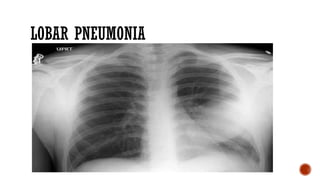pneumonia in adults. causes, epidemiology, clinical presentation and ...