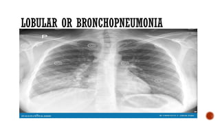pneumonia in adults. causes, epidemiology, clinical presentation and ...