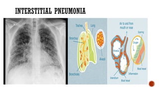 pneumonia in adults. causes, epidemiology, clinical presentation and ...