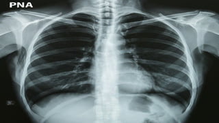 pneumonia in adults. causes, epidemiology, clinical presentation and ...