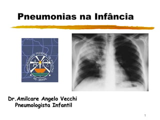 1
Pneumonias na Infância
Dr.Amilcare Angelo Vecchi
Pneumologista Infantil
 