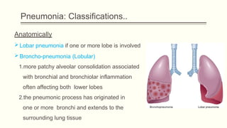 pneumonia- class for undergraduate students. | PPTX
