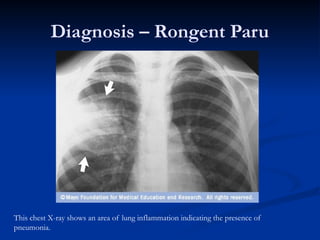 PNEUMONIA-dr-SaptoSP.PDdemi keshatan anak_.pptx