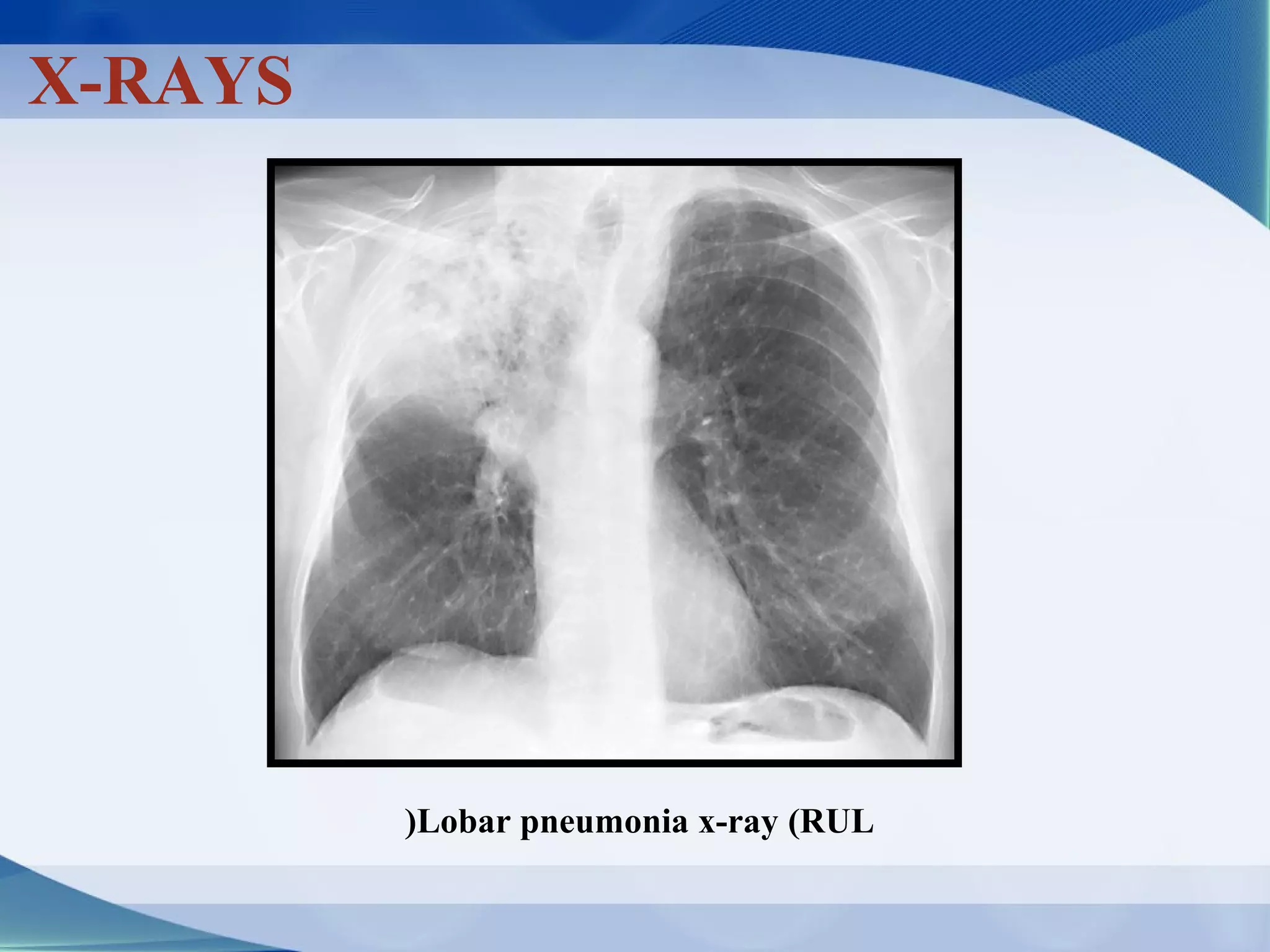 classification of pnemonia | PPT