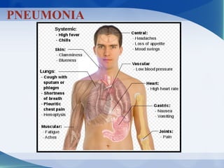 PNEUMONIA
 