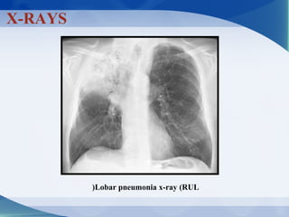 X-RAYS
Lobar pneumonia x-ray (RUL(
 