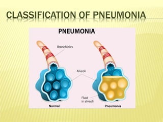 CLASSIFICATION OF PNEUMONIA
 