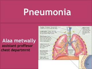 Alaa metwally
assistant proffesor
chest departmrnt
Pneumonia
 