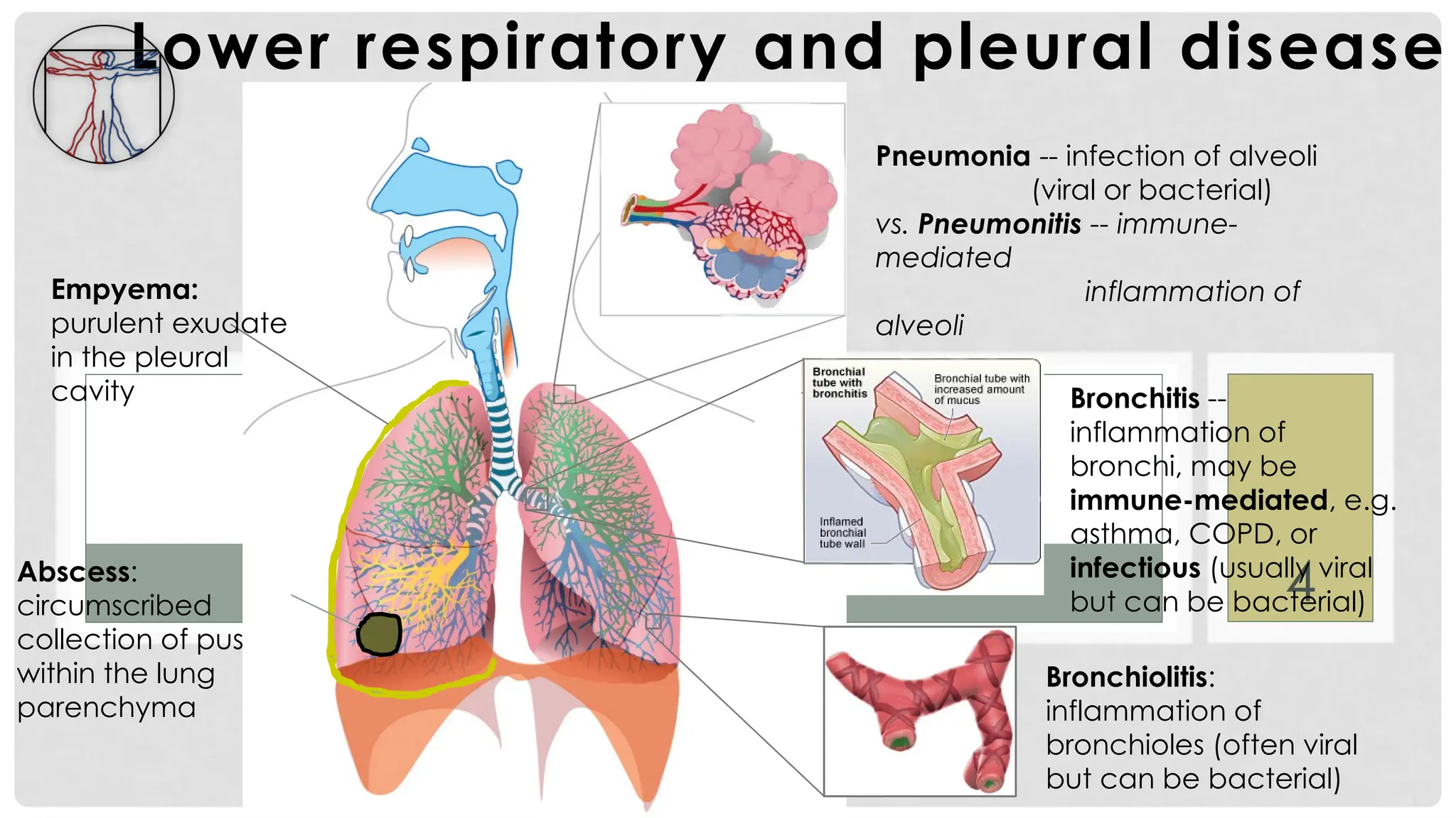 4
Lower respiratory and pleural disease
Pneumonia -- infection of alveoli
(viral or bacterial)
vs. Pneumonitis -- immune-
mediated
inflammation of
alveoli
Bronchitis --
inflammation of
bronchi, may be
immune-mediated, e.g.
asthma, COPD, or
infectious (usually viral
but can be bacterial)
Empyema:
purulent exudate
in the pleural
cavity
Abscess:
circumscribed
collection of pus
within the lung
parenchyma
Bronchiolitis:
inflammation of
bronchioles (often viral
but can be bacterial)
 