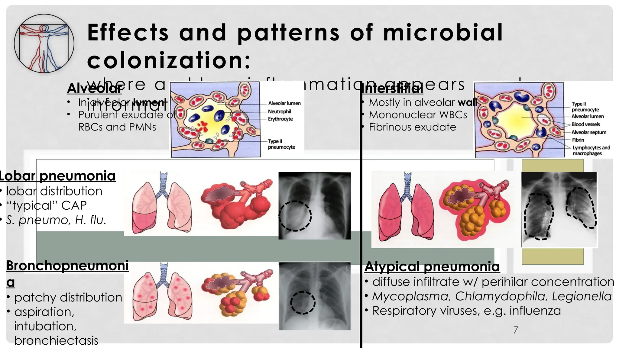 Effects and patterns of microbial
colonization:
where and how inflammation appears can be
informative
7
Alveolar
• In alveolar lumen
• Purulent exudate of
RBCs and PMNs
Interstitial
• Mostly in alveolar wall
• Mononuclear WBCs
• Fibrinous exudate
Lobar pneumonia
• lobar distribution
• “typical” CAP
• S. pneumo, H. flu.
Bronchopneumoni
a
• patchy distribution
• aspiration,
intubation,
bronchiectasis
Atypical pneumonia
• diffuse infiltrate w/ perihilar concentration
• Mycoplasma, Chlamydophila, Legionella
• Respiratory viruses, e.g. influenza
 