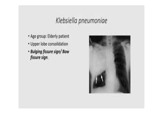 PNEUMONIA A CLINICAL APPROACH AND MANAGEMENT | PPTX