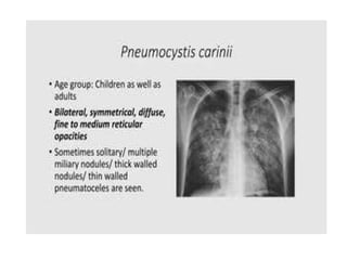 PNEUMONIA A CLINICAL APPROACH AND MANAGEMENT | PPTX